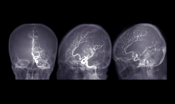 Cerebral angiography AP,Oblique and Lateral view image from Fluoroscopy in intervention radiology showing cerebral artery.