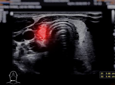 Ultrasonography of thyroid gland for diagnostics of the thyroid gland.