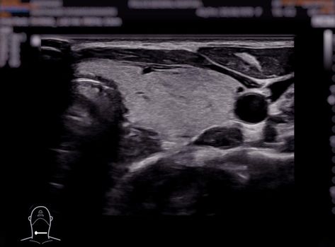 Ultrasonography of thyroid gland for diagnostics of the thyroid gland.