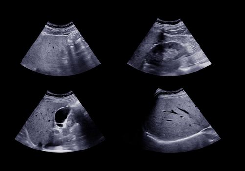 Ultrasound upper abdomen showing liver , gallbladder and kidney.