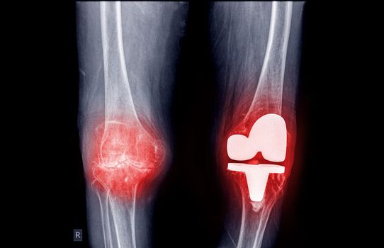 film x-ray both knee AP view of osteoarthritis knee patient and artificial joint with knee replacement.