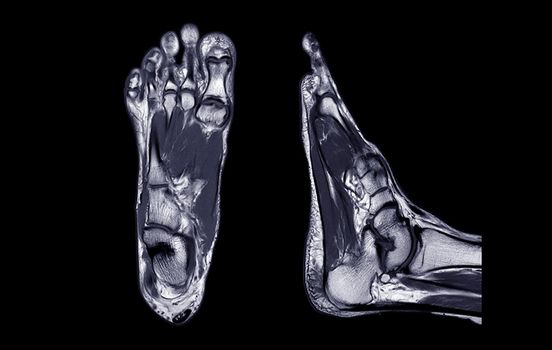 Manetic resonance imaging of foot or MRI FOOT PDW axial, Coronal and sagittal view for diagnostic tendon injury.