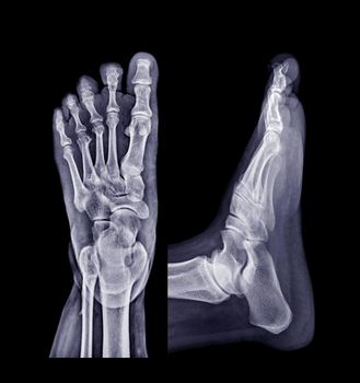 Foot x-ray image AP and Lateral view isolated on black background.