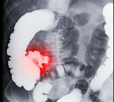 barium enema demonstrated cecum and colon for diagnosis Colorectal cancer or colon cancer.