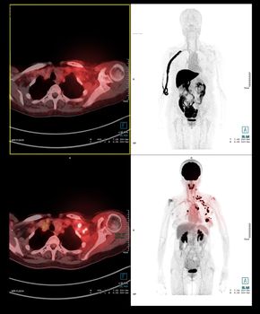 PET Scan image of whole human body for detect cancer recurrence after surgery. medical technology concept.