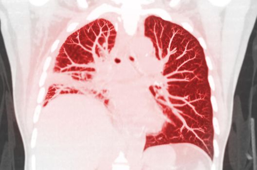 CT scan of Chest or lung coronal mip view of lung infection covid-19 with ground glass opacity .