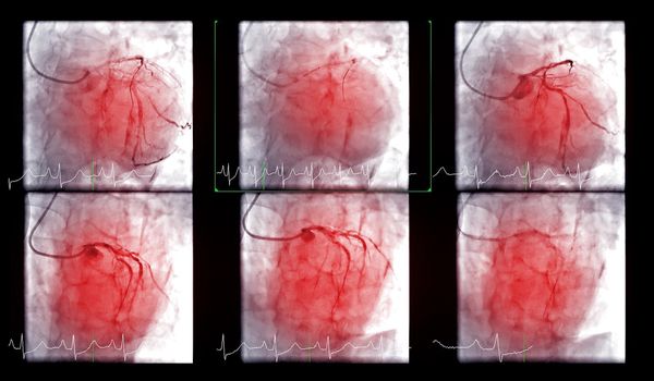 Cardiac catheterization is a test used to find out cardiac arrest .