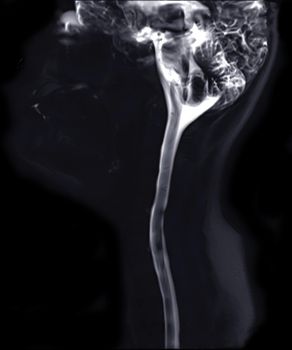 MRI cervical spine myelogram seqeunce for diagnostic Spinal Cord Compression.