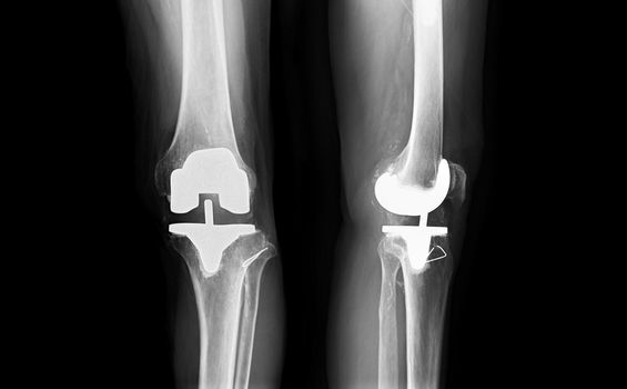 film x-ray Left knee AP and lateral view of osteoarthritis knee patient and artificial joint with Knee Replacement.