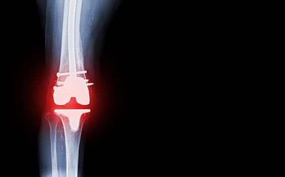 film x-ray knee AP view of osteoarthritis knee patient and artificial joint with Knee Replacement.