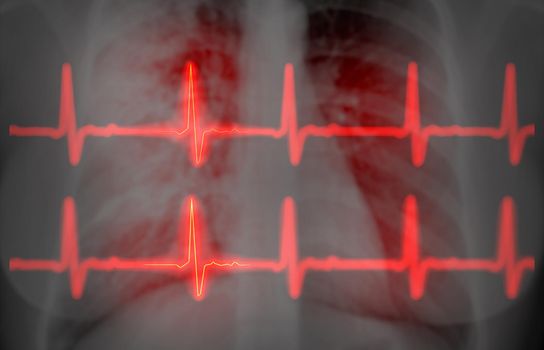 CHEST X-ray with EKG 3D rendering image for diagnosis of vessel coronary artery stenosis .