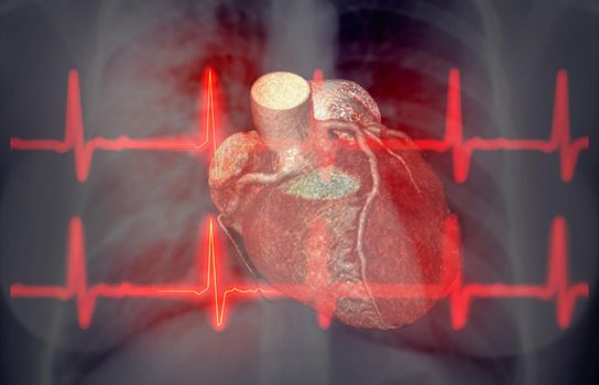 CHEST X-ray with EKG 3D rendering image for diagnosis of vessel coronary artery stenosis .