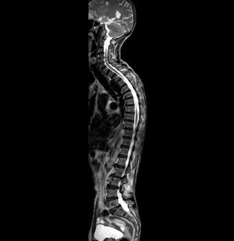 MRI of whole spine T2W sagittal plane for diagnostic Spinal Cord Compression.