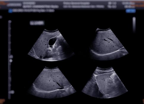 Ultrasound upper abdomen showing gallbladder for diagnosis gallbladder stone.