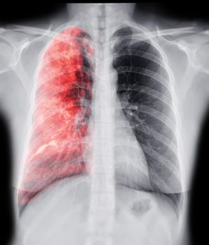 Chest X-ray with Lung 3D rendering image for diagnosis TB,tuberculosis and covid-19 .