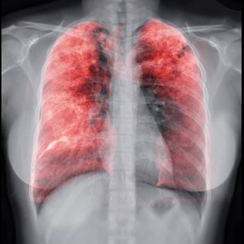 Chest X-ray with Lung 3D rendering image for diagnosis TB,tuberculosis and covid-19 .