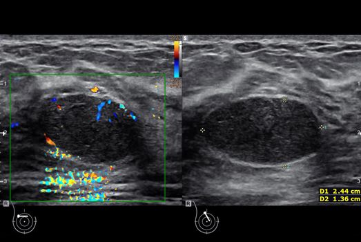 ultrasound breast of Patient after mammogram for diagnonsis Breast cancer in women isolated on black background.