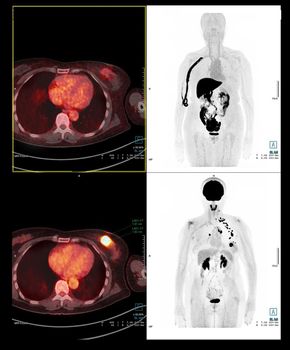 PET Scan image of whole human body for detect cancer recurrence after surgery. medical technology concept.