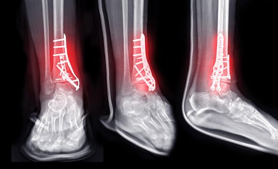X-ray image of ankle joint showing surgical treatment by internal fixation with plate and screw.