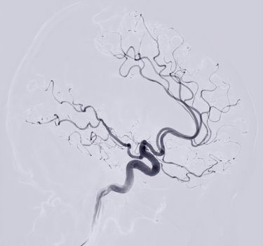 Cerebral angiography Lateral view image from Fluoroscopy in intervention radiology showing cerebral artery.