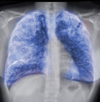 Lung 3D rendering image for diagnosis TB,tuberculosis and covid-19 from CT-Scanner 3D.