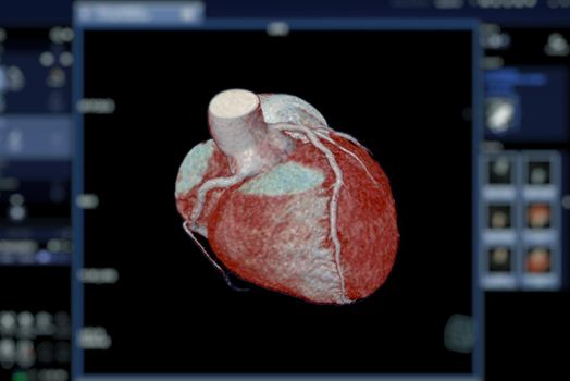 CTA Coronary artery 3D rendering image on the screen for diagnosis of vessel coronary artery stenosis .