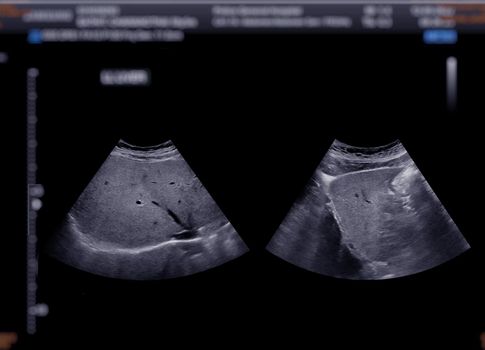 Ultrasound upper abdomen showing liver.