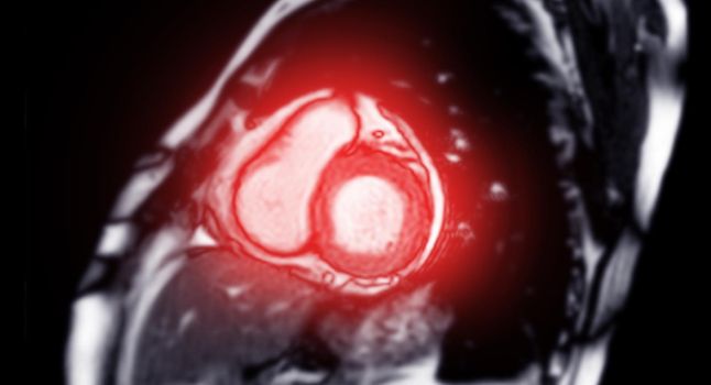 MRI heart or Cardiac MRI ( magnetic resonance imaging ) of heart short axis for diagnosis heart disease.