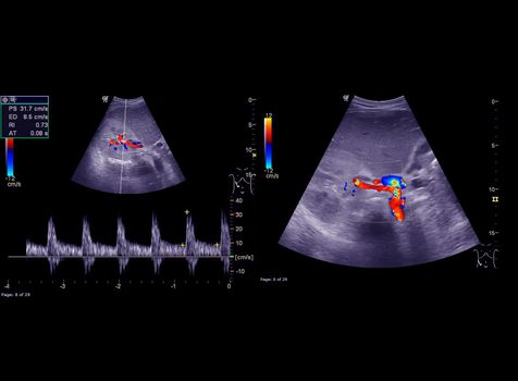 Ultrasound upper abdomen showing flow in common bile duct after use color Doppler.
