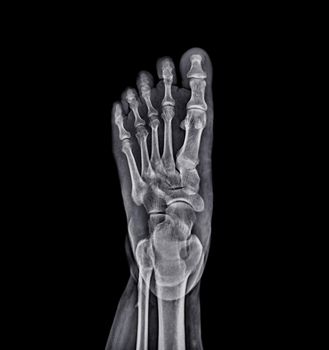 Foot x-ray image isolated on black background.