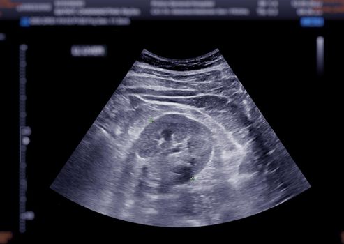Ultrasound upper abdomen showing kidney.