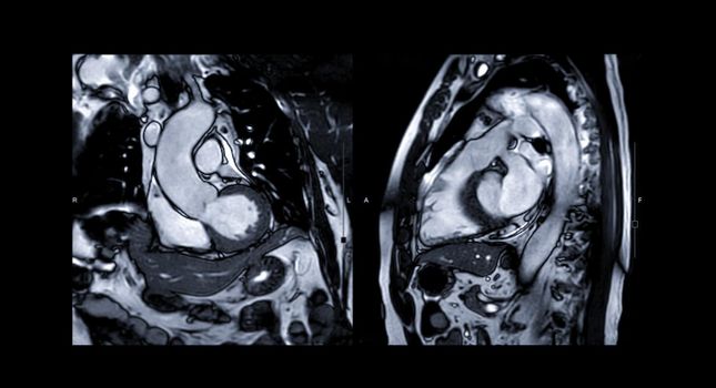 MRI heart or Cardiac MRI ( magnetic resonance imaging ) of heart compare RVOT and LVOT for diagnosis heart disease.