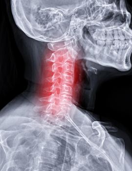 X-ray C-spine or x-ray image of Cervical spine oblique view for diagnostic intervertebral disc herniation.