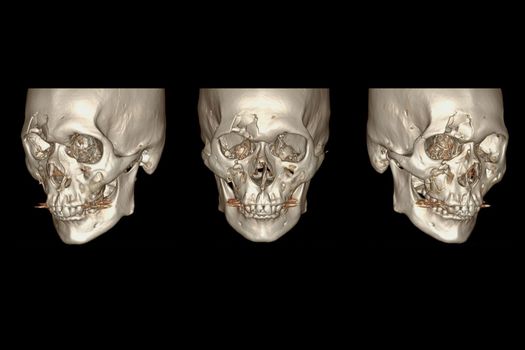 CT Facial Bone 3D rendering image isolated on black background showing fracture frontal bone .