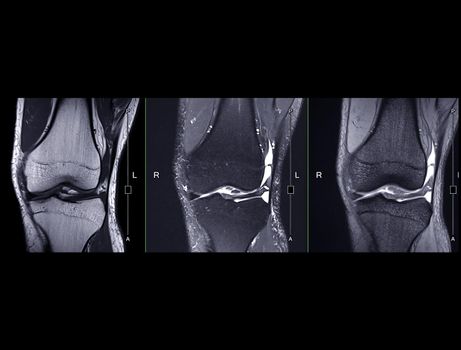 Magnetic resonance imaging or MRI knee comparison Coronal view for detect tear or sprain of the anterior cruciate ligament (ACL). clipping path.