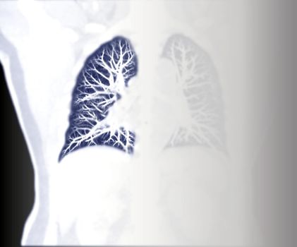 Selective Focus of CT Chest Coronal MIP view for diagnostic Pulmonary embolism (PE) , lung cancer and covid-19. .