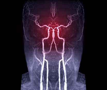 MRA Brain or Magnetic resonance angiography ( MRA ) of cerebral artery for evaluate them aneurysm , stenosis and stroke disease.