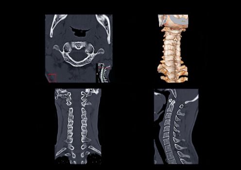 Compare of CT C-Spine or Cervical spine axial view , 3D Rendering image , Corona and sagittal view in patient trauma cervical spine injury.