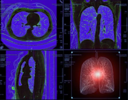 Selective focus of CT Chest or Lung 3D rendering image on the monitor for diagnosis TB,tuberculosis and covid-19 .