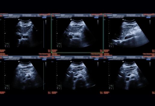 Ultrasound upper abdomen showing Liver ,kidney, pancrease and gall bladder for detect HCC or Gall stone.