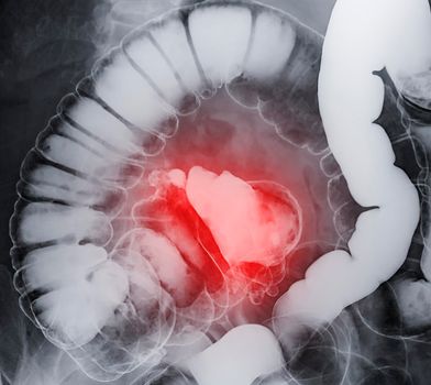 barium enema demonstrated cecum and colon for diagnosis Colorectal cancer or colon cancer.