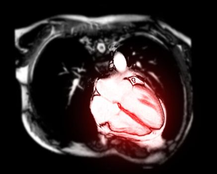 MRI heart or Cardiac MRI ( magnetic resonance imaging ) of heart vertical axis view showing 4 chamber of the heart for diagnosis heart disease.