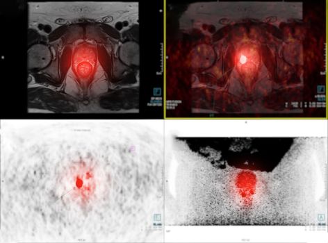 PET/MRI prostate gland fusion imaging in high-grade prostate cancer.