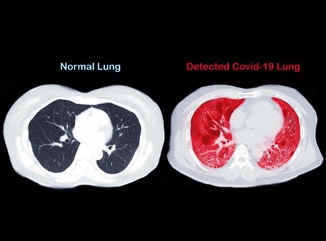 Compare CT scan of Chest axial view of normal lung and lung infection covid-19 isolated on black background. Clipping path.