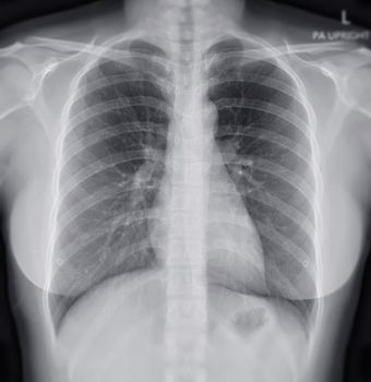 Chest X-ray Of Human Chest or Lung showing normal lung.