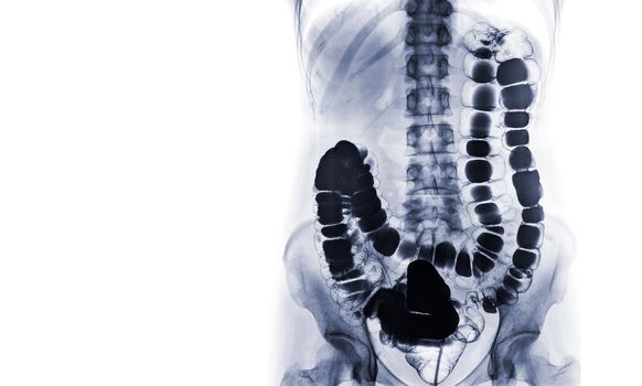 Barium enema or BE is image of large bowel after injection of barium contrast fill into colon under fluoroscopic control isolated on white background.