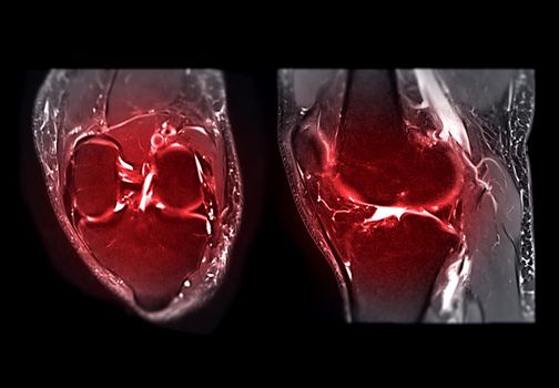 Magnetic resonance imaging of the knee or MRI knee T2W fat suppreesion for detect tear or sprain of the anterior cruciate ligament (ACL).