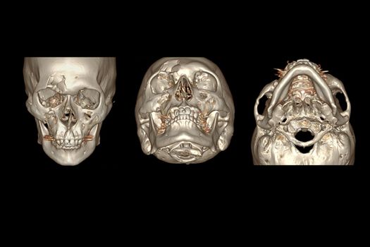 CT Facial Bone 3D rendering image isolated on black background showing fracture frontal bone .