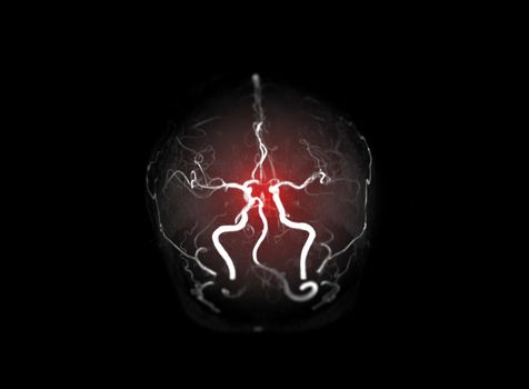 Collection of MRA brain or Magnetic resonance angiography image ( MRA ) of cerebral artery in the brain for detect stroke disease.