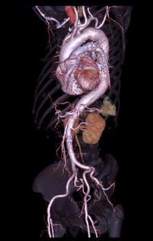 CTA abdominal aorta 3D rendering image on transparent skeletal .